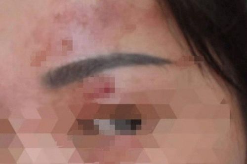 Bỏng giác mạc chỉ vì bất cẩn khi giặt đồ