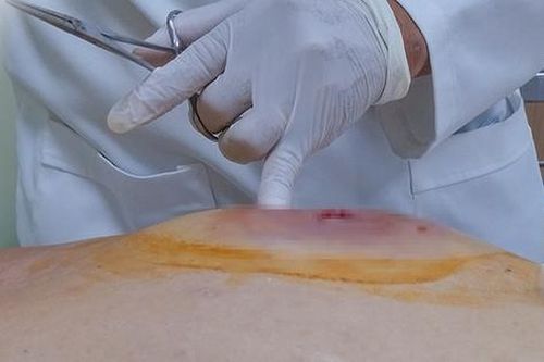 Người đàn ông 41 tuổi phát hiện bệnh tiểu đường từ dấu hiệu cảnh báo bệnh, nhưng người Việt thường bỏ qua