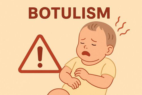 Cần xử lý ra sao khi nghi ngờ trẻ nhiễm botulism?