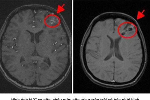 Chẩn đoán nhanh bằng MRI, cô gái 25 tuổi thoát nguy cơ xuất huyết não