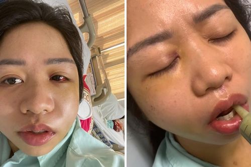 Vụ chó gây tai nạn ở Lào Cai: Công an xã Bảo Hà tiếp tục xác minh sau phản ánh