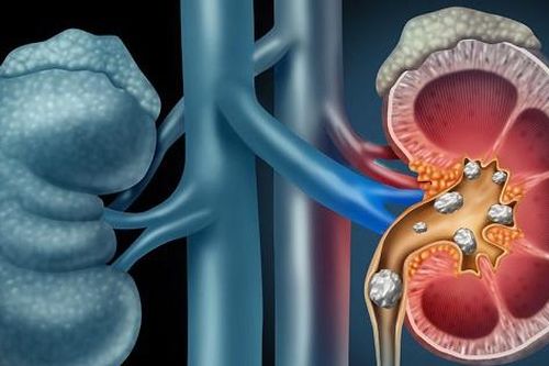 Cách điều trị bệnh sỏi thận đúng cần biết