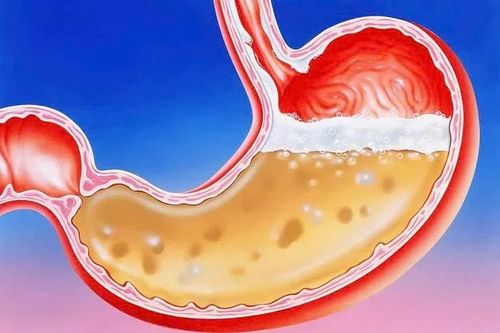 Thói quen xấu gây tăng axit dạ dày