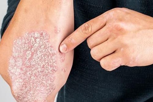 Bệnh vảy nến: dấu hiệu nhận biết và những ai có nguy cơ cao?