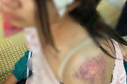 Cục Bà mẹ và Trẻ em lên tiếng vụ cháu bé bị bạo hành tại Thái Nguyên