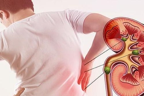 Đau lưng âm ỉ một năm, người đàn ông 54 tuổi phát hiện thận bị phá hủy bởi sỏi san hô khổng lồ
