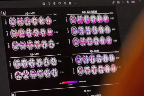 Hãng dược Novo Nordisk thất bại trong thử nghiệm thuốc điều trị Alzheimer