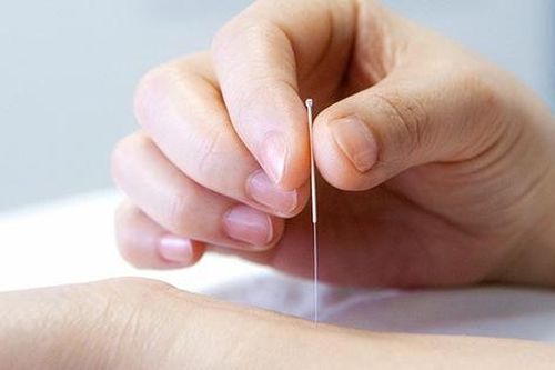 Châm cứu điều trị viêm tuyến tiền liệt: Giải pháp Đông y giảm đau, ngừa tái phát