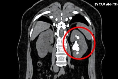 Lấy sỏi san hồ lấp đầy đài bể thận cho người phụ nữ 51 tuổi