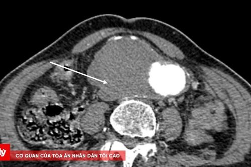 Hành trình 5 giờ giành lại sự sống cho cụ ông 81 tuổi tại Bệnh viện Hữu Nghị