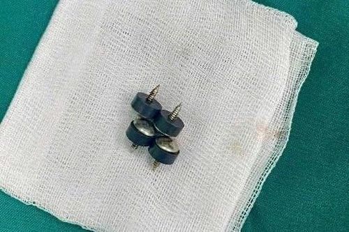 Bệnh nhi 2 tuổi ở Nghệ An nuốt 4 viên đinh nam châm đầu nhọn nguy hiểm