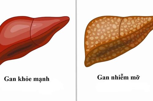 Người bị xơ gan, gan nhiễm mỡ do rượu bao lâu nên khám một lần?