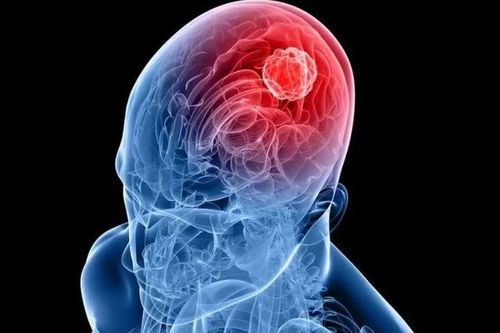 Tin vui cho các bệnh nhân u nguyên bào thần kinh đệm