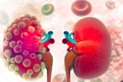 Đau lưng kéo dài, người đàn ông 60 tuổi phát hiện ung thư thận hiếm gặp