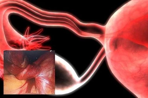 Phẫu thuật cấp cứu thành công cho bé gái 14 tuổi mắc u nang buồng trứng xoắn