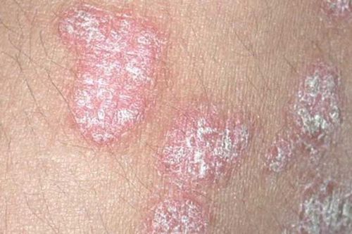 7 cách giảm triệu chứng vảy nến hiệu quả trong mùa đông