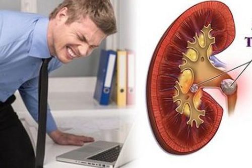 Đau lưng, tiểu són đề phòng sỏi thận
