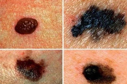 Ung thư tế bào hắc tố trên da có nguy hiểm không?