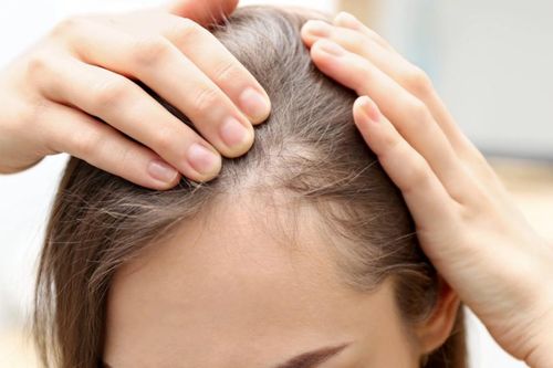 Thuốc giảm cân GLP-1 có nguy cơ gây rụng tóc?