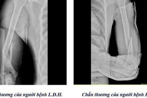 Cảnh báo nguy cơ gẫy xương cánh tay từ trò vật tay