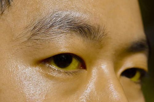 Dấu hiệu cảnh báo bệnh gan biểu hiện trên mặt
