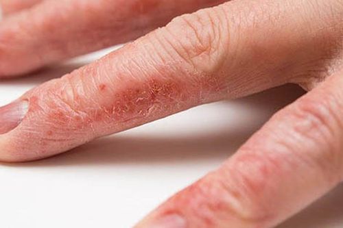 Làm cách nào để khắc phục da tay khô nứt nẻ vào mùa đông?
