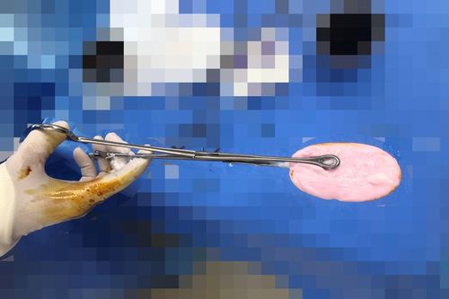 Bé gái 12 tuổi nhập viện với vùng kín chảy máu