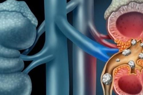 Những cách phòng tránh sỏi thận hiệu quả, ai cũng nên áp dụng