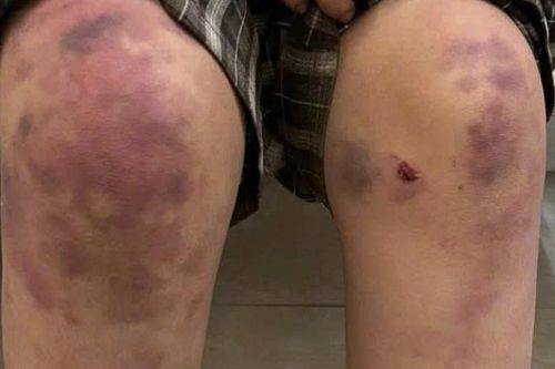 Bé gái 13 tuổi bị bạo hành ở Thái Nguyên mong được về sống cùng dì