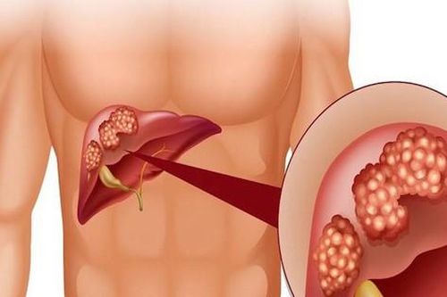 Cảnh giác với giãn tĩnh mạch thực quản