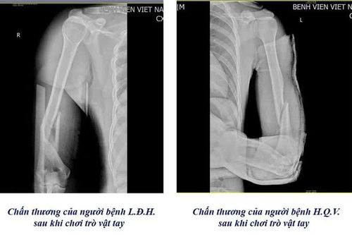 1 tuần 3 trường hợp gãy xương cánh tay từ trò chơi vật tay