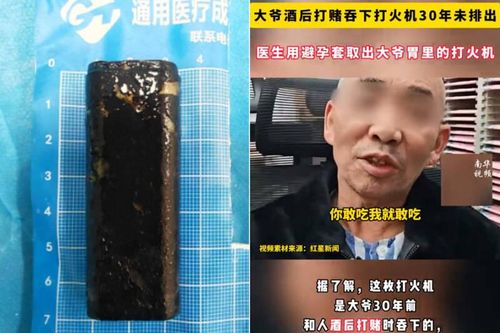 Người đàn ông Trung Quốc sống cùng bật lửa trong dạ dày suốt 30 năm