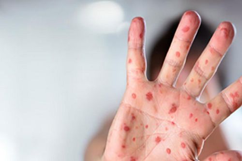 WHO cảnh báo: Căn bệnh không có thuốc chữa đang lây lan nhanh trở lại