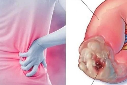 Người đàn ông 43 tuổi phát hiện ung thư thận, thừa nhận một sai lầm nhiều người Việt mắc phải