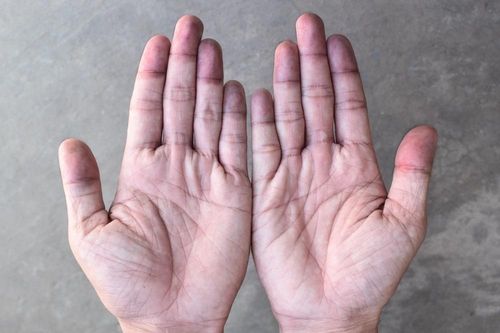 Triệu chứng của thận yếu biểu hiện ở da