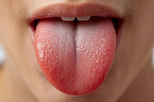 Màu sắc của lưỡi tiết lộ gì về tim mạch?