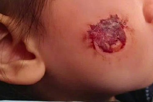 Bé gái 3 tuổi bị bỏng rộp cả mặt vì 'miếng dán đồ chơi': Nhiều đồ chơi hot trên mạng tuyệt đối không mua