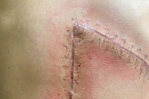 Cứu sống thiếu niên sốc mất máu do vỡ lách độ 5 sau tai nạn giao thông