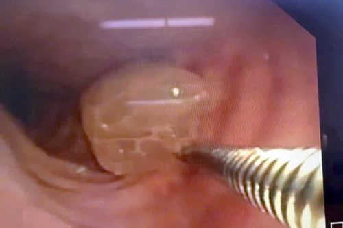 Cứu sống bệnh nhân bị hóc nho xanh gây tắc nghẽn đường thở