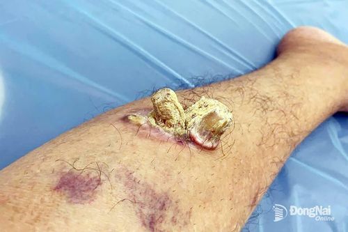 Điều trị u nhú tế bào gai sừng hóa bằng laser