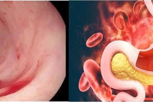 Phân biệt xuất huyết tiêu hóa và bệnh di truyền huyết học