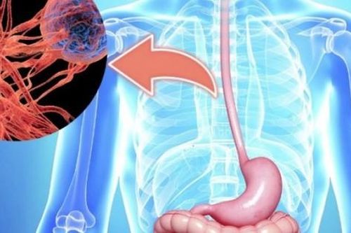 Những món người Việt yêu thích không ngờ làm tăng nguy cơ mắc ung thư thực quản