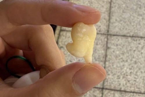 Răng khôn 'nhảy chân sáo' gây sốt MXH: Bác sĩ giải thích khi nào nhổ