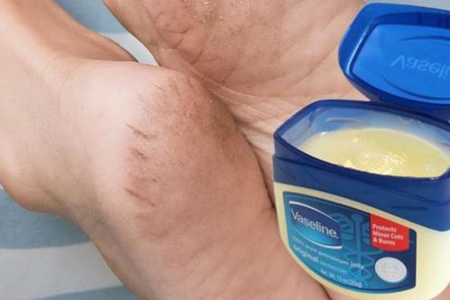 Cách khắc phục tình trạng da gót chân khô, nứt nẻ mùa đông