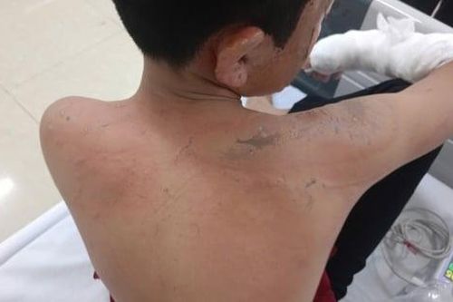 Trẻ bỏng nặng vì nghịch pháo, cảnh báo nguy hiểm dịp cận Tết