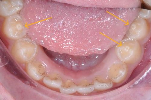 Răng có núm phụ – nguy cơ biến chứng nếu không điều trị kịp thời