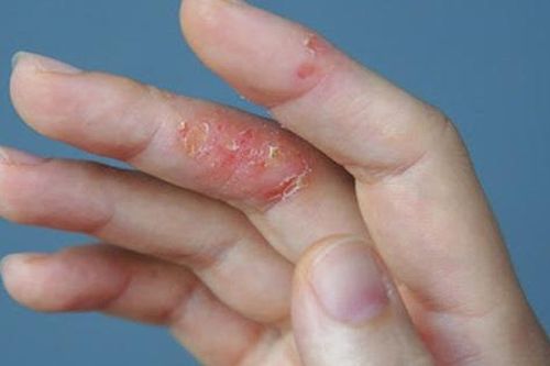 Bệnh viêm da cơ địa tăng nặng khi thời tiết lạnh, khô