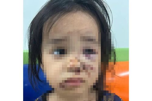 Bé gái 4 tuổi nhập viện vì bị chó thả rông tấn công