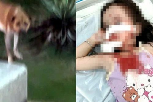 TP Hồ Chí Minh: Bé gái 4 tuổi bị chó tấn công, thương tích nghiêm trọng vùng mặt
