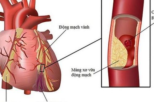 5 biện pháp giảm nguy cơ biến cố tim mạch khi thời tiết lạnh